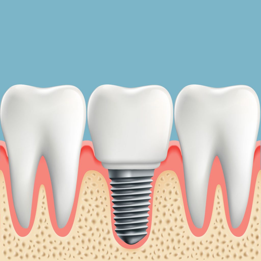 Dental Implantlar